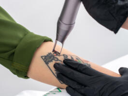 Cosmetologist removing tattoo with laser device female hand. Concept of erasing tattoos as expensive procedure in cosmetology clinic