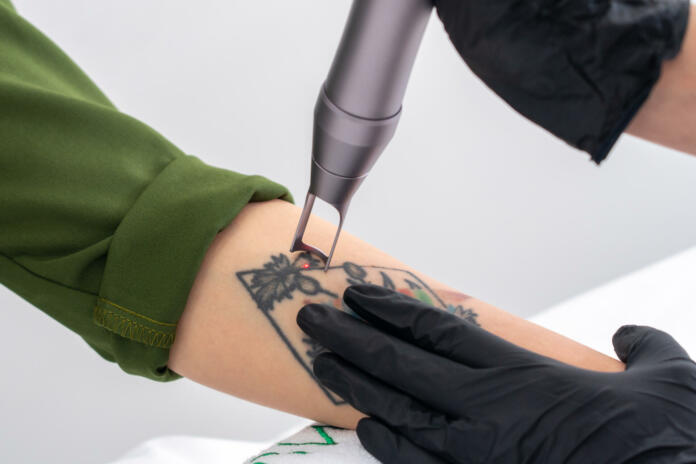 Cosmetologist removing tattoo with laser device female hand. Concept of erasing tattoos as expensive procedure in cosmetology clinic