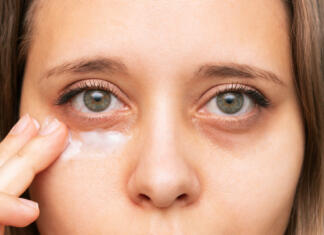 Temni kolobarji in otekline, ki nam niso v ponos Cropped shot of a young caucasian woman touching a skin of her face while applying the cream for black eyes. Bruises under the eyes are caused by fatigue, nervousness, lack of sleep, insomnia, stress