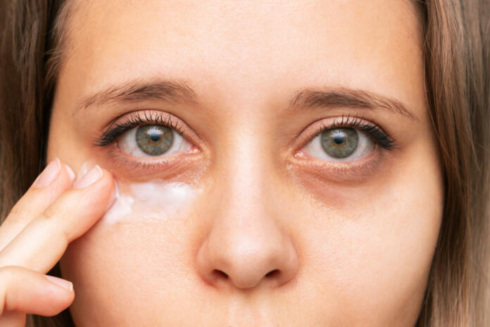 Cropped shot of a young caucasian woman touching a skin of her face while applying the cream for black eyes. Bruises under the eyes are caused by fatigue, nervousness, lack of sleep, insomnia, stress