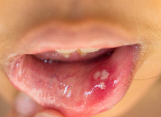 Afta! Ne že spet! mouth ulcer or canker sore or aphthous stomatitis or aphthous ulcer