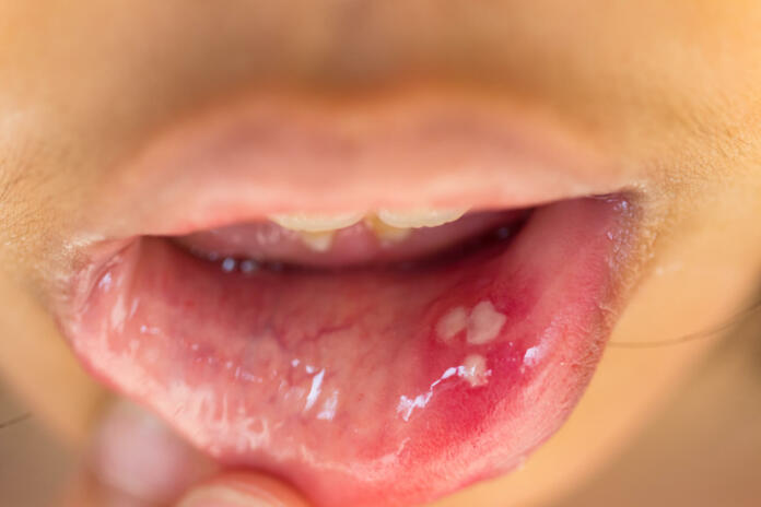 mouth ulcer or canker sore or aphthous stomatitis or  aphthous ulcer