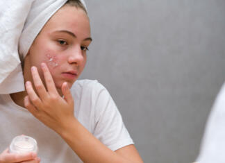 Acne. A teenage girl applying acne medication on her face in front of a mirror. Care for problem skin