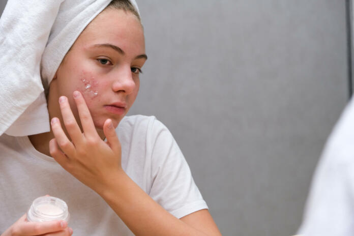 Acne. A teenage girl applying acne medication on her face in front of a mirror. Care for problem skin