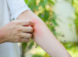 Zakaj te komarji lahko vedno zavohajo? Man itching and scratching on arm from allergy skin rash cause by Mosquitoes bite