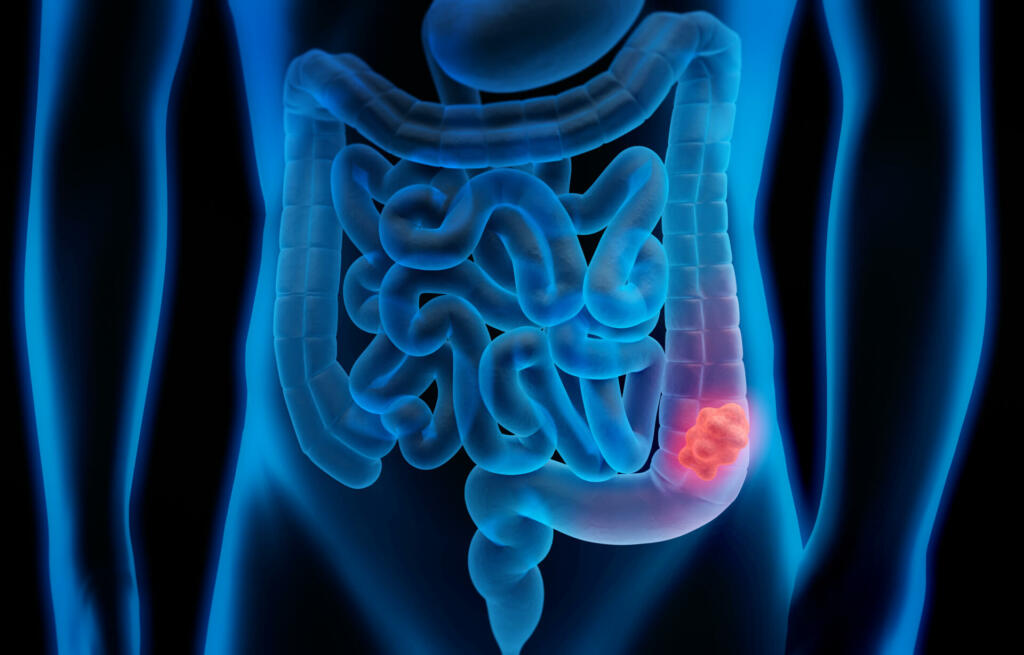 Medical illustration of Colorectal Cancer - Polyp