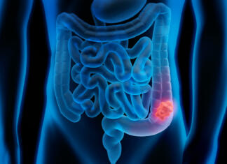 Prehrana in tveganje za zgodnji nastanek raka na debelem črevesu Medical illustration of Colorectal Cancer - Polyp