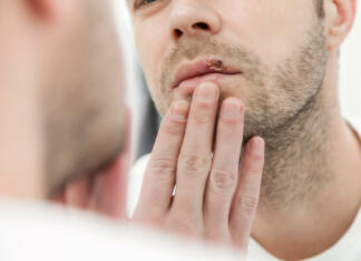 Herpes: Kako se ga znebiti in ostali nasveti Young man suffering from painful herpes on his mouth
