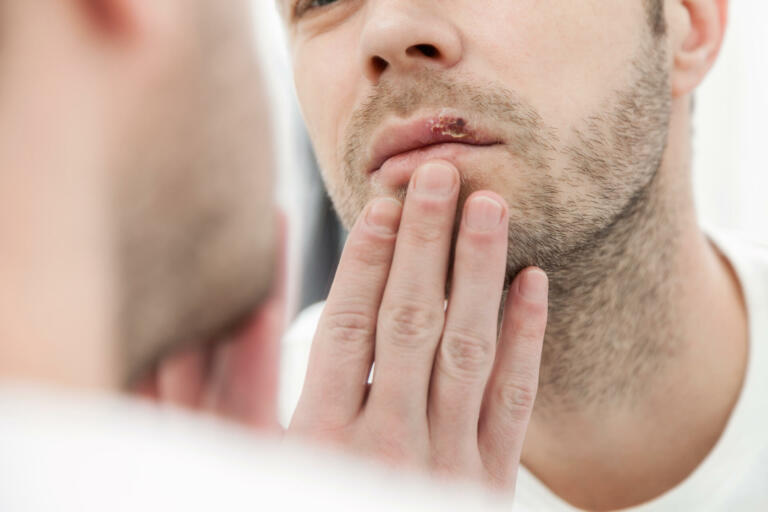 Young man suffering from painful herpes on his mouth