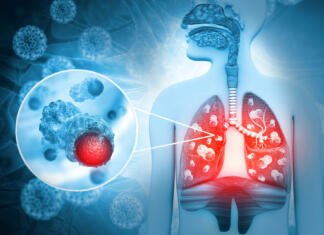 Kako lahko zrak vpliva na razvoj pljučnega raka? Lung cancer diagnosis and Human lungs disease. 3d illustration