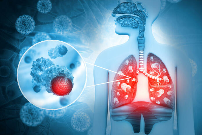 Lung cancer diagnosis and Human lungs disease. 3d illustration