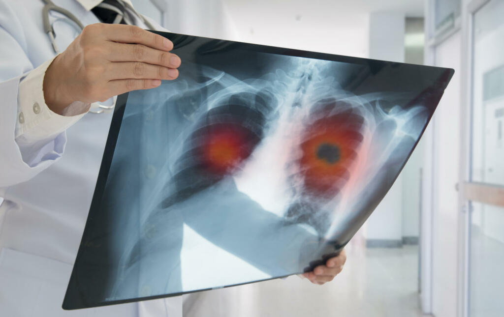 Lung Cancer. Doctor check up x-ray image have problem lung tumor of patient.