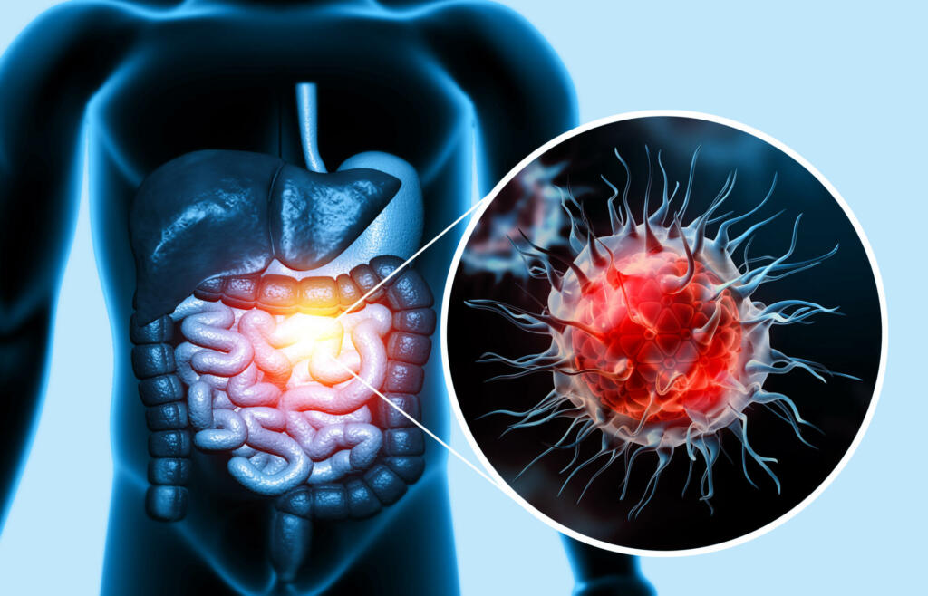 Colon cancer. Cancer attacking cell. Colon disease concept. 3d illustration