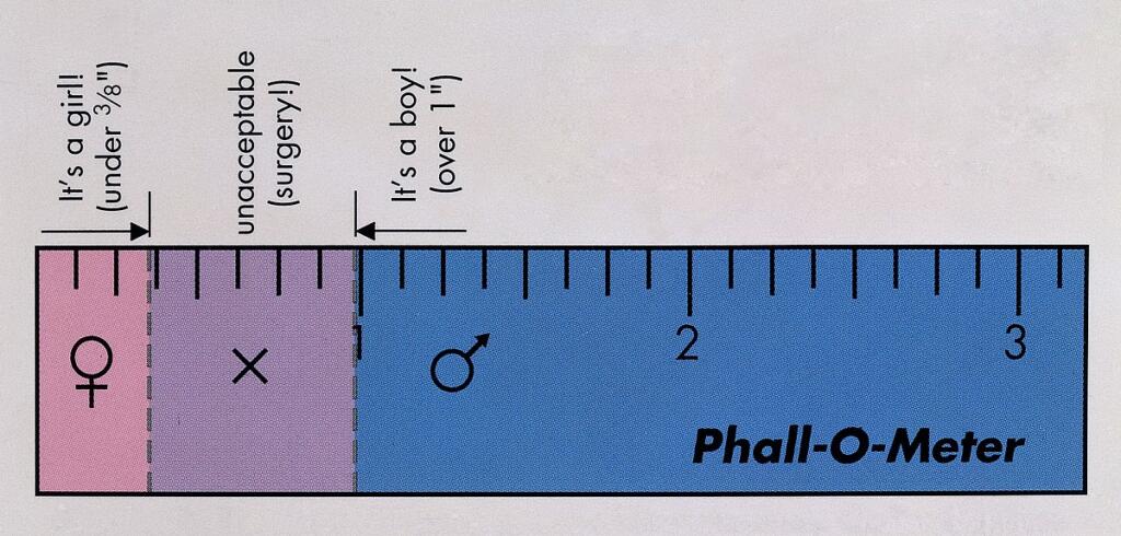 Phall-O-Meter ali kriterij za operacije intersplonih novorojenčkov