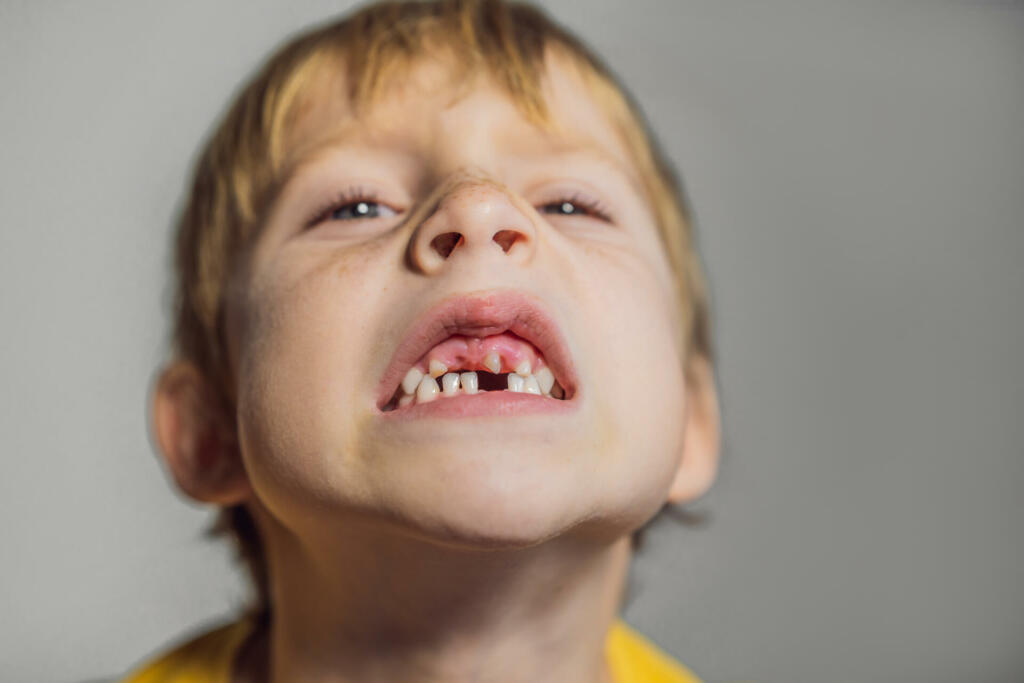 Abnormal boy tooth. The extra narrow strange tooth grew in the boy's mouth. Boy shows his crooked tooth. Patient Orthodontist. Children's teeth problems.