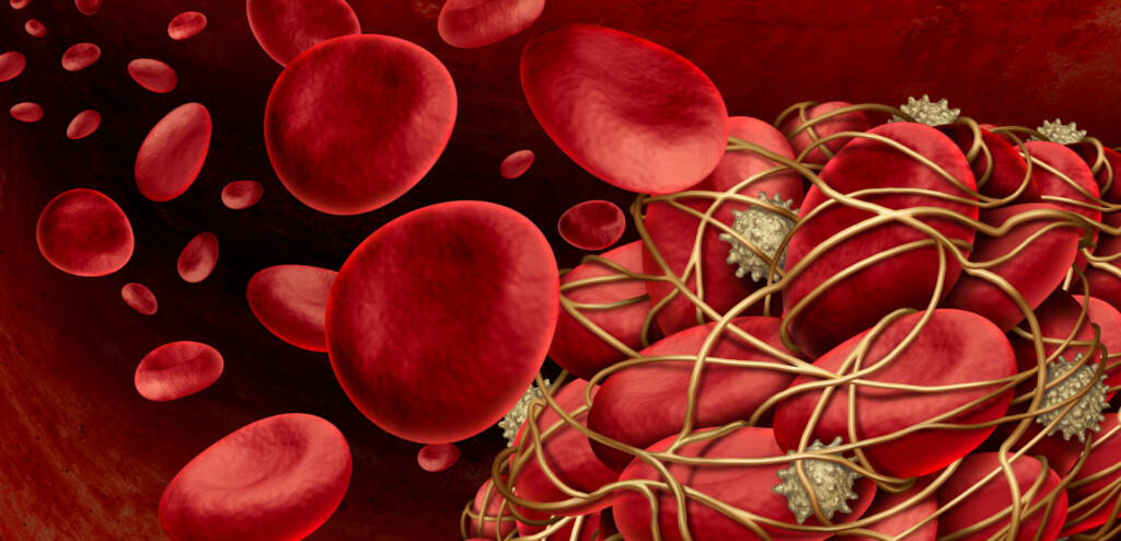 Blood clot and thrombosis medical illustration concept as a group of human blood cells clumped together by sticky platelets and fibrin creating a blockage in an artery or vein as a health disorder as a 3D illustration.