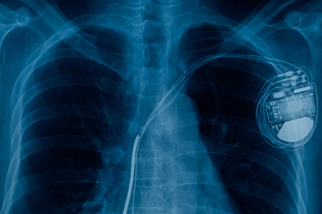 pacemaker cell x-ray image