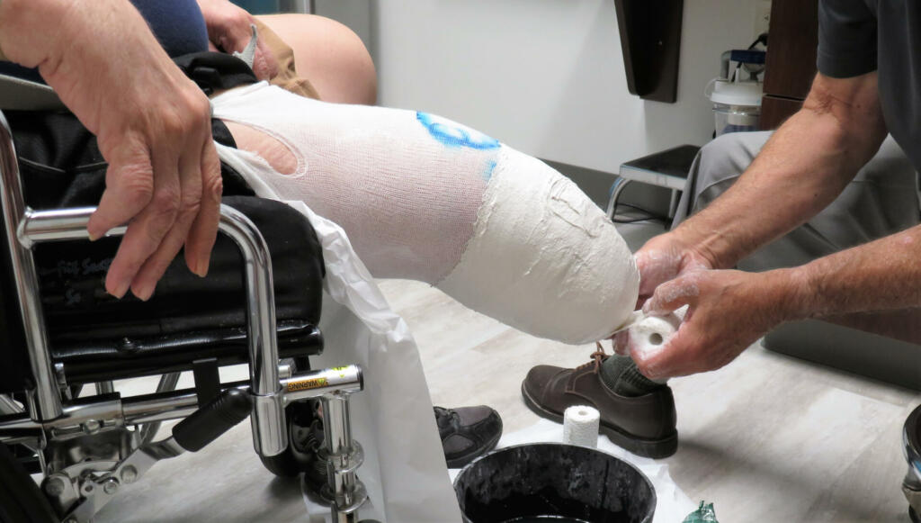 A male prosthetist wraps a plaster cast around the leg stump (amputated limb) of an disables amputee veteran in a wheelchair.