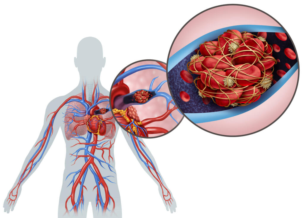 Pulmonary Embolism with a blood clot as a disease with a blockage of an artery in the lungs with 3D illustration elements.
