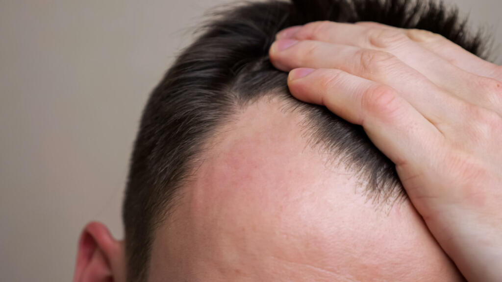 Young man examines his bald spots in the mirror.