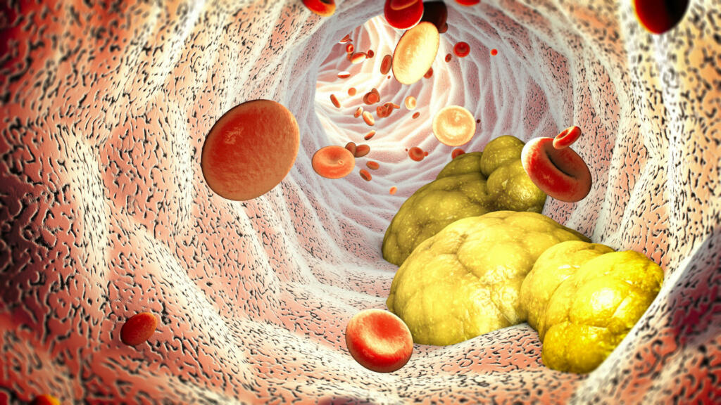 Cholesterol formation, fat, artery, vein, heart. Red blood cells, blood flow. Narrowing of a vein for fat formation