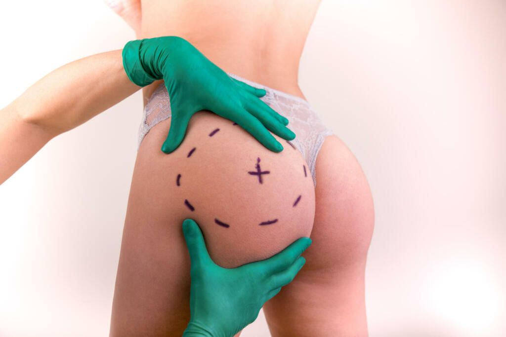 Surgeon drawing marks on female body before plastic operation, white background. Liposuction concept