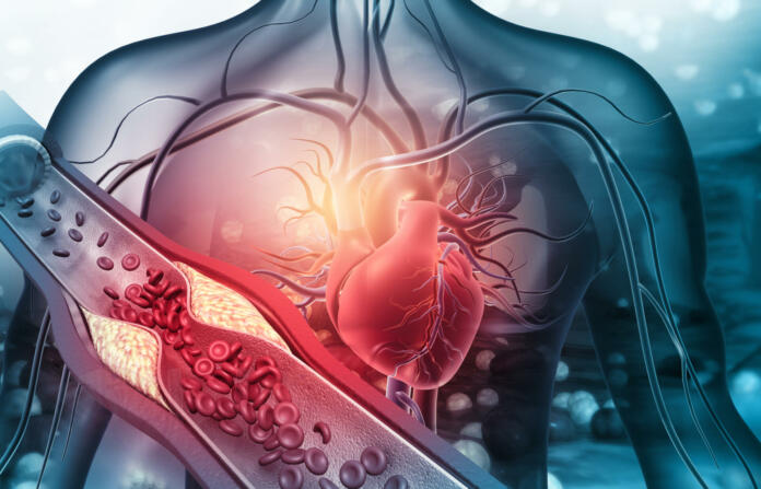 Human heart with blocked arteries. 3d illustration