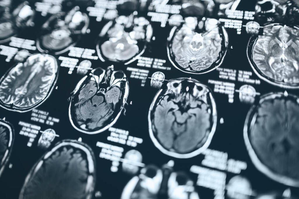 MRI head scan, magnetic resonance imaging of head.