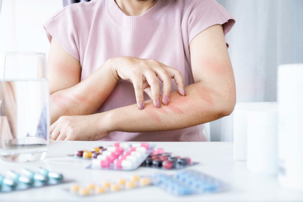 A Woman Experiencing Allergic Reaction to Medication, Scratching Itchy Skin on Arm due to Side Effect