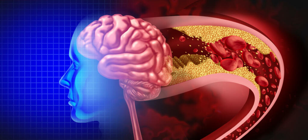 Brain Stroke Attack as a Cerebral arteriosclerosis disease as a blocked artery due to plaque buildup with 3D illustration elements.