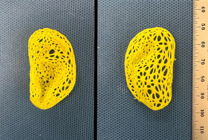 Plastično ogrodje replike človeškega ušesa, ki so ga naredili znanstveniki Plastično ogrodje replike človeškega ušesa, ki so ga naredili znanstveniki