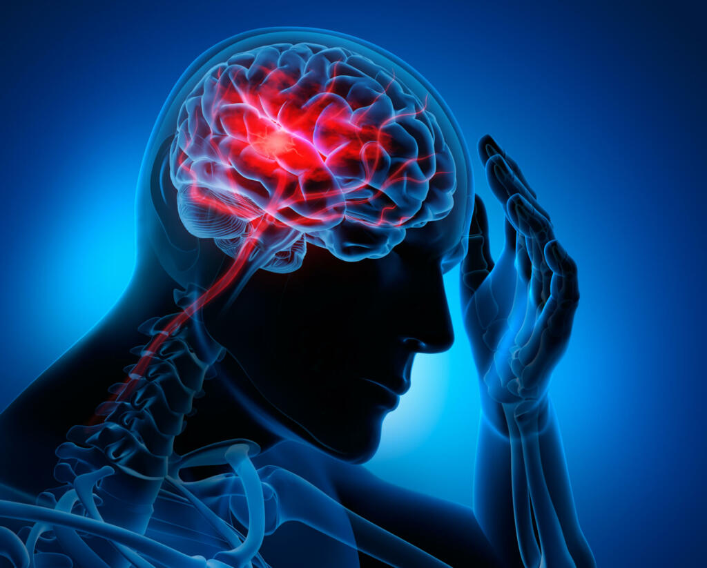 Medical illustration of a brain with stroke symptoms