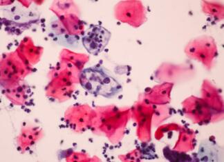 Odločitev, ki prepreči več vrst rakov bf a