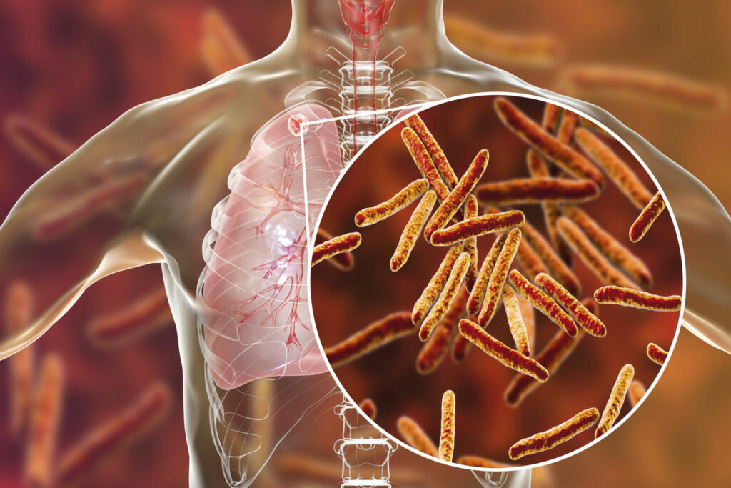 Secondary tuberculosis in lungs and close-up view of Mycobacterium tuberculosis bacteria, 3D illustration