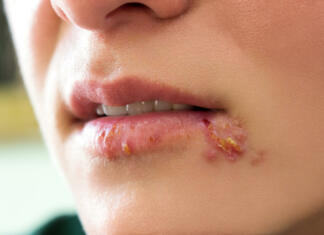 Kako se znebiti herpesa čez noč? Kako se znebiti herpesa?