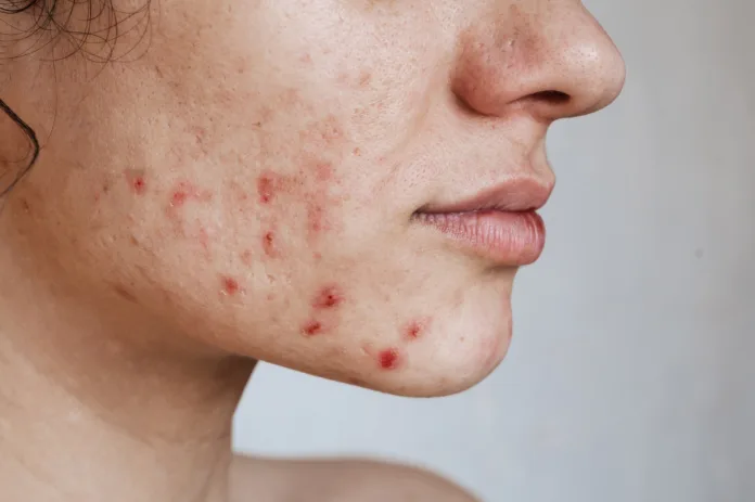 close-up-of-the-skin-of-a-young-girl-with-problems-pimples-acne-pores-scars-natural-skin-without-filters-stockpack-istock Close-up of the skin of a young girl with problems. Pimples, acne, pores, scars. Natural skin without filters.