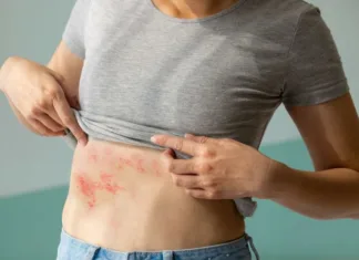 Norice: Vse prej kot nedolžna otroška bolezen zooster