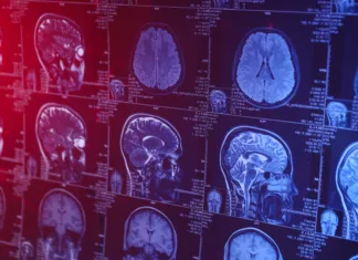 Te beljakovin so povezane z našim staranjem MRI or magnetic resonance imaging of the head and brain. Close up