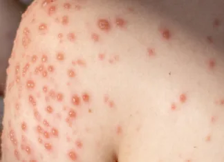 Poznate nevarnosti noric?