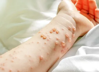 Če lahko svojega otroka zaščitimo pred bolečino in trpljenjem, zakaj bi tvegali? norice