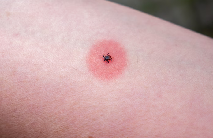 tick-u200bu200bis-on-an-arm-with-a-red-sore-stockpack-istock Tick "u200b"u200bis on an arm with a red sore