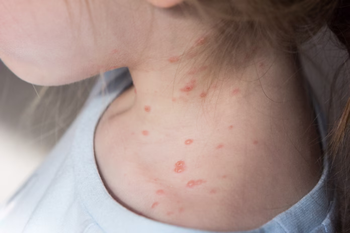 chickenpox-is-an-infectious-disease-it-causes-a-spotty-itchy-rash-on-the-body-some-people-have-a-few-spots-while-others-can-have-a-lot-the-spots-fill-with-a-fluid-under-the-top-layer-of-the-skin-creat-stockpack-istock Chickenpox is an infectious disease. It causes a spotty itchy rash on the body. Some people have a few spots while others can have a lot. The spots fill with a fluid under the top layer of the skin creating bubble-like sac vesicles. These blisters eventually turn into scabs.