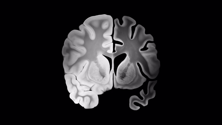Moški možgani se krčijo hitreje, a ženske pogosteje z Alzheimerjem