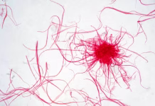 Rak v Sloveniji: kaj delamo dobro in kje zaostajamo cancer celss