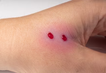 Kri moškega, ki se je pustil 202-krat ugrizniti kačam, je pomagala razviti novo protistrupno zdravilo Snake bite on skin, snakebite or cat bite marks close up. Two small fresh blood drops on hand skin with copy space