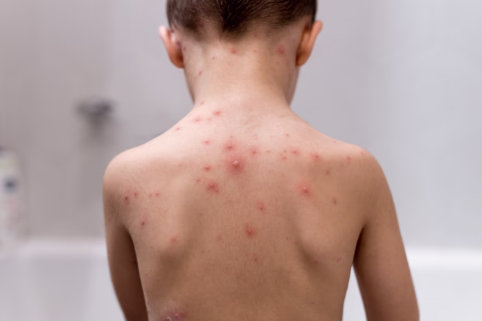 boy-with-chickenpox-rash-on-child-body-close-up-stockpack-istock Boy with chickenpox. Rash on child body close up.