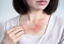 Kako se znebiti pršic? Pomagajo vam lahko ti nasveti Close-up of a woman with red, itchy skin on her neck from a rash, caused by dryness, allergies, eczema, or sweating in hot weather