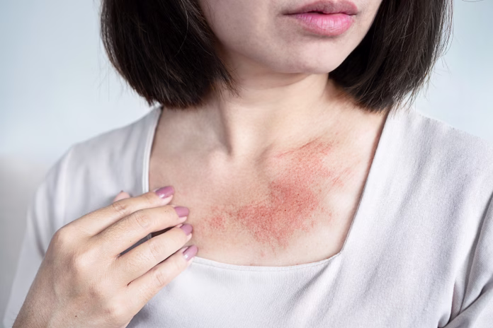 Close-up of a woman with red, itchy skin on her neck from a rash, caused by dryness, allergies, eczema, or sweating in hot weather
