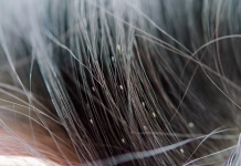 Kako se znebiti naglavnih uši? Louse egg on the hair causes itchy head.