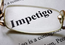 Kaj je impetigo? Paper with word Impetigo and glasses. Medical concept.